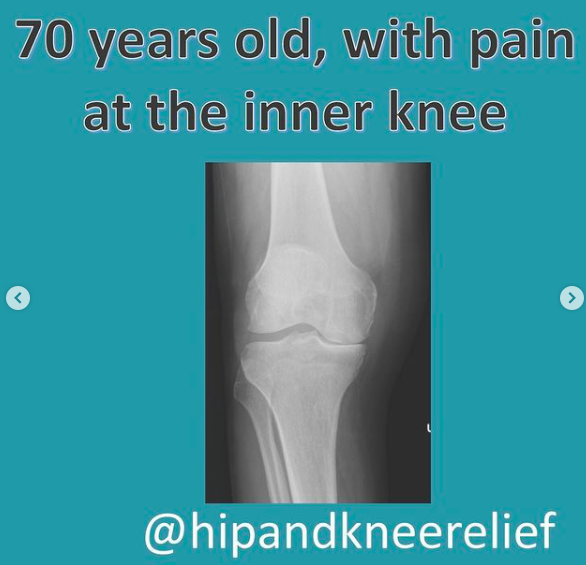 Partial Knee Replacement