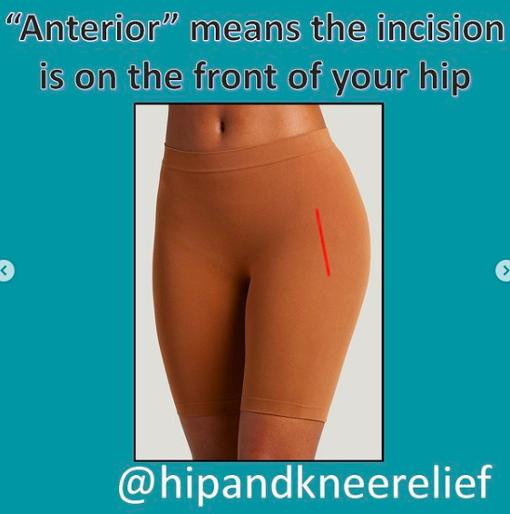 What is Direct Anterior Total Hip Replacement?