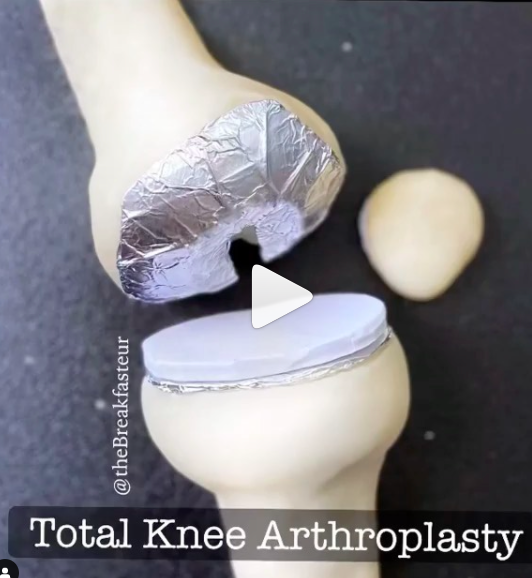 Play Dough total knee replacement