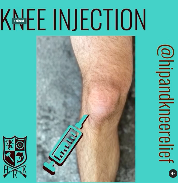 Intra-articular injections