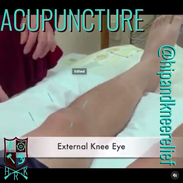 Acupuncture for arthritis