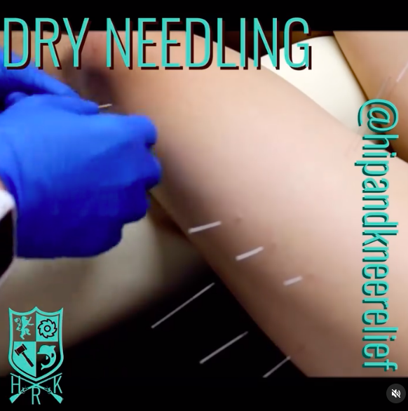 Dry needling for arthritis