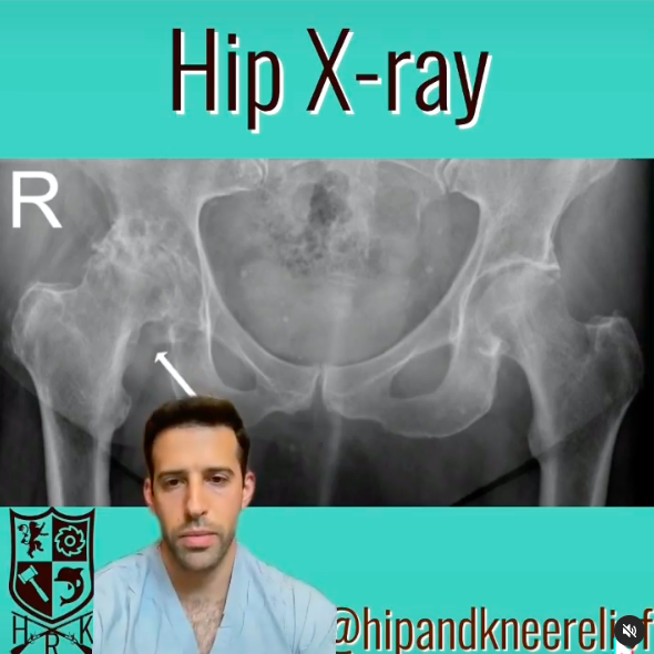 Hip arthritis x-ray review