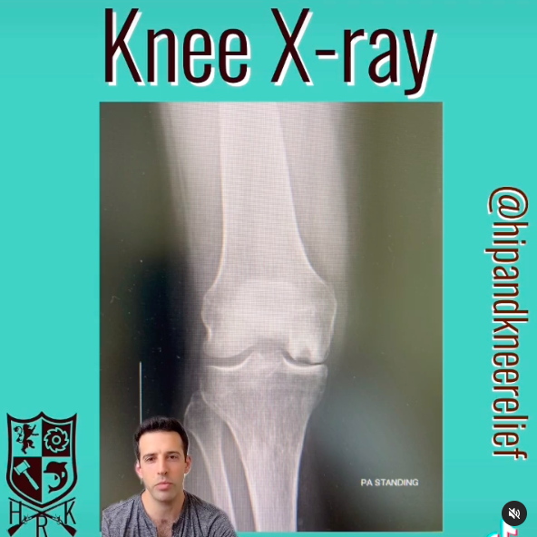 Partial knee replacement x-ray review video